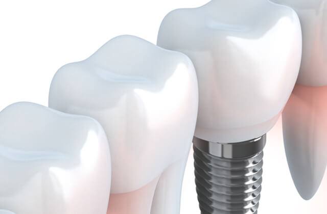 インプラントイメージ