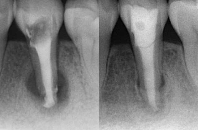 根管治療イメージ