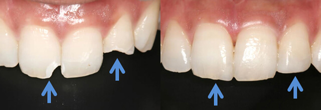 ダイレクトボンディングイメージ