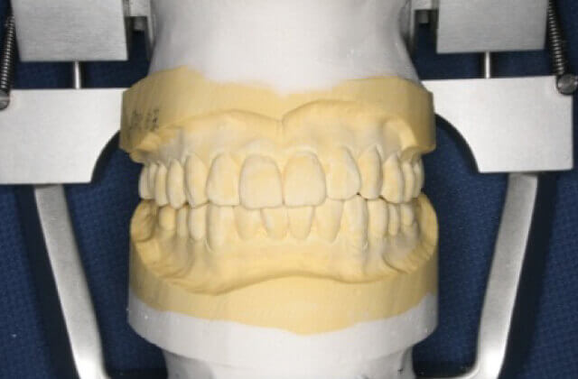 歯型を使った咬合器診査