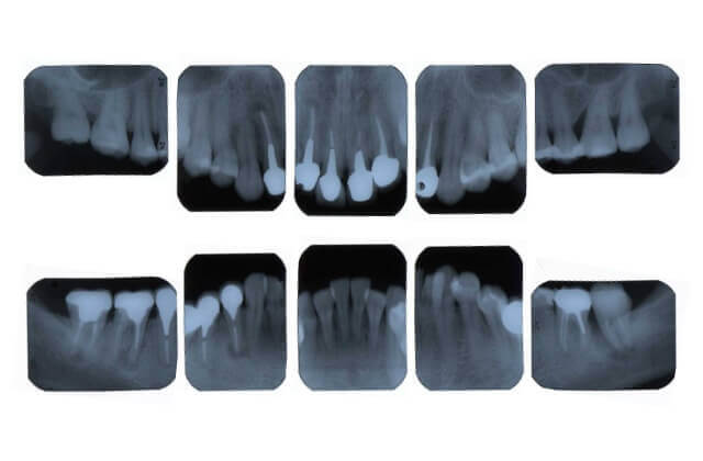 デンタル10枚法