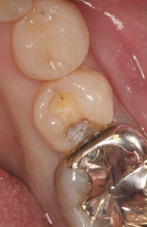 詰め物が取れた