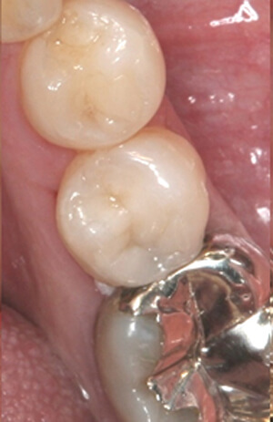 ダイレクトボンディング治療後