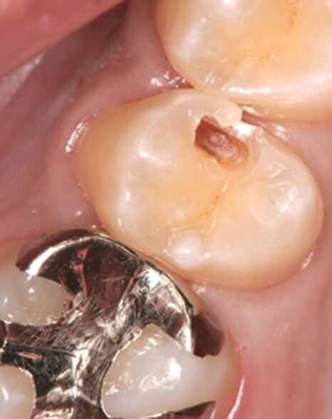 虫歯が進行した部分のみを除去