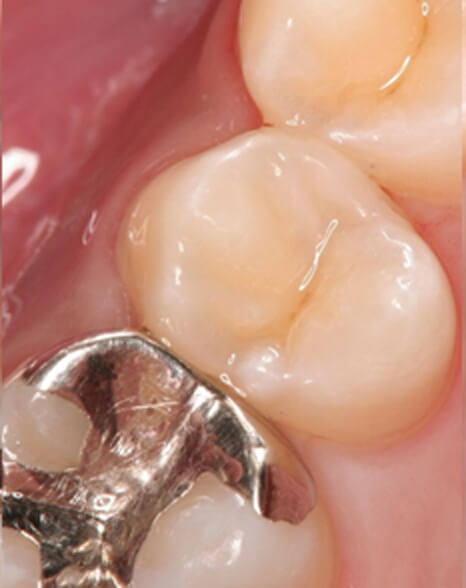 ダイレクトボンディング　治療後