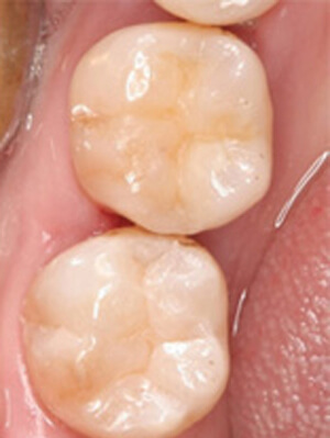 ダイレクトボンディング　治療後