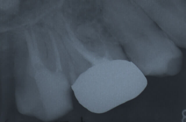 マイクロエンド終了時