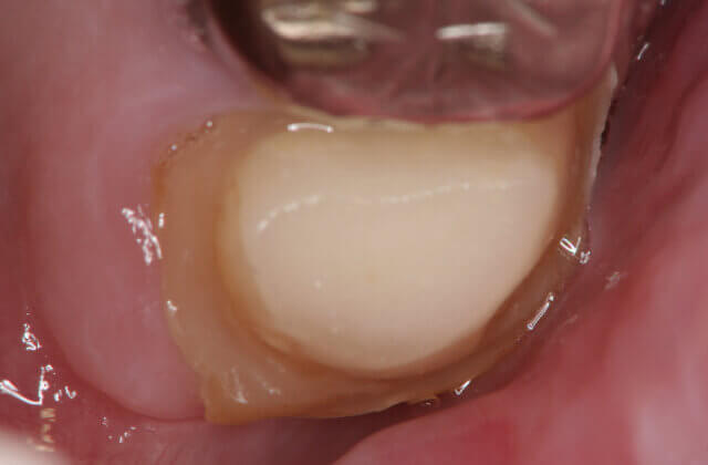 患歯を傷が付かないように丁寧に抜きます