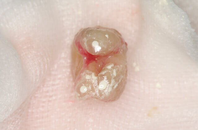 病巣切除した所に適切な薬剤（MTA)を使用します