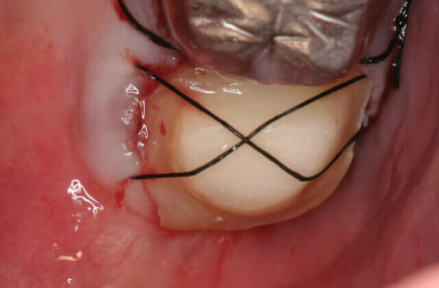 病巣を切除した患歯を元の場所に戻しました