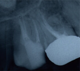 マイクロエンド終了時（症状は依然続いています