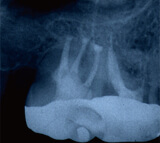 再生後5年後	骨の再生が認められたため完全治癒を確認できました