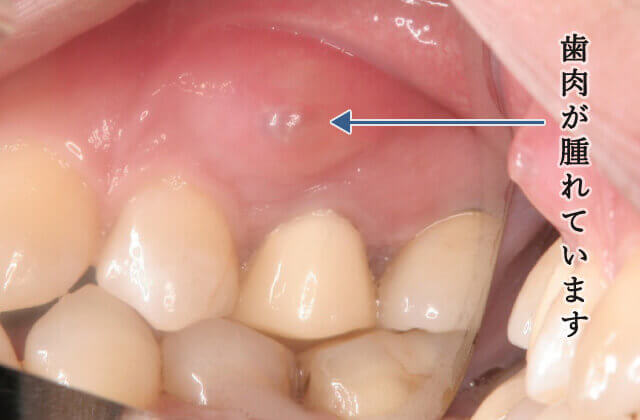 歯肉が腫れています