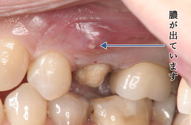 エンドサージェリー治療