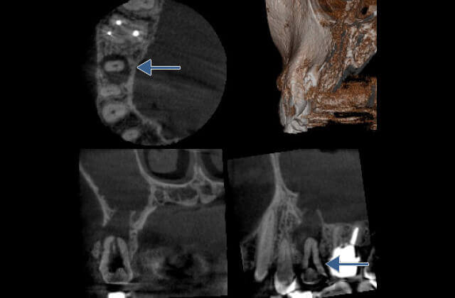 エンドサージェリー治療