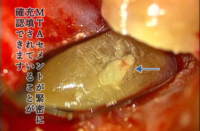 MTAセメントによる緊密な封鎖