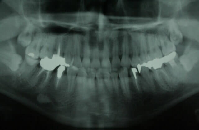 レントゲン写真