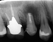 エンドサージェリー直後