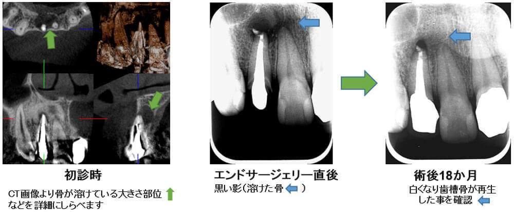 エンドサージェリー治療例01