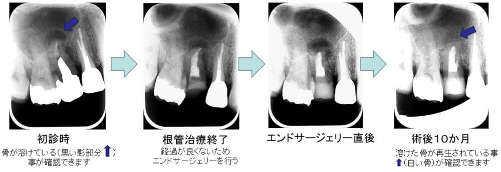 エンドサージェリー治療例02