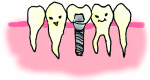 インプラント01