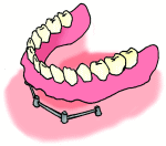 インプラント05