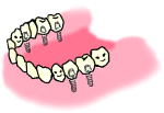 インプラント07
