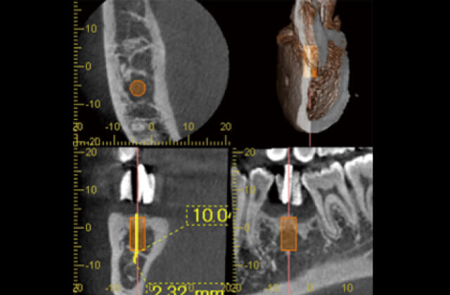 インプラント10