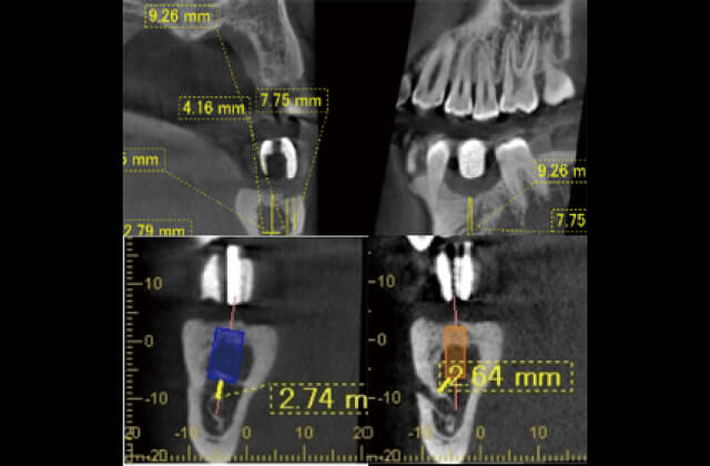 インプラント11