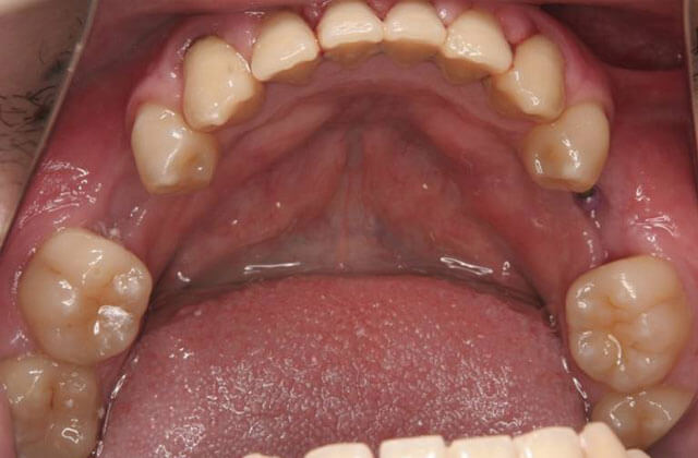 インプラント治療例