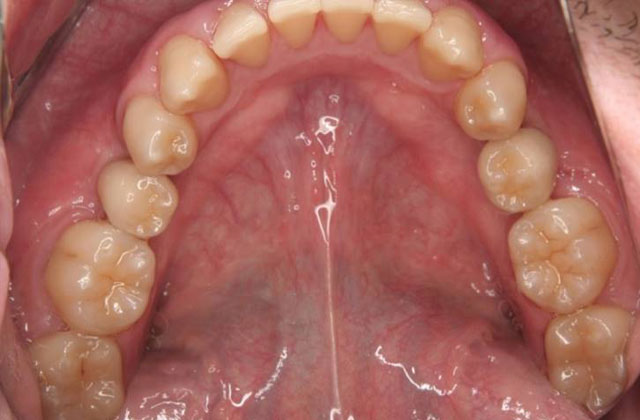インプラント治療例