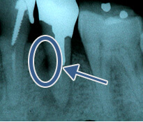 根管治療が必要な病態