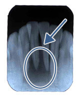 歯根周囲の大きな黒い影