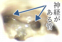 マイクロスコープ所見