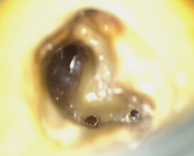 歯のなかの細菌を除去