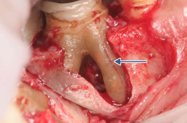 歯根破折に対する保存治療症例
