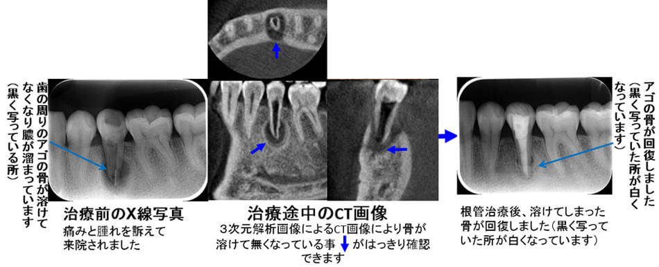 東京の歯科専門医による根管治療後、溶けた骨が回復