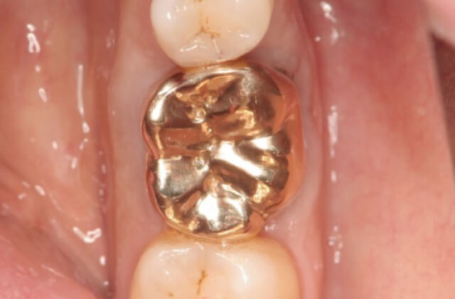 金歯による修復