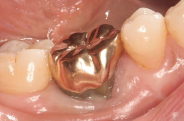 金歯による修復