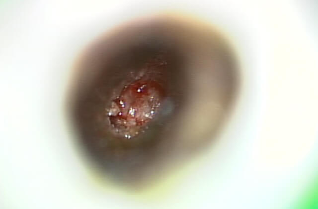 根尖部の肉芽組織