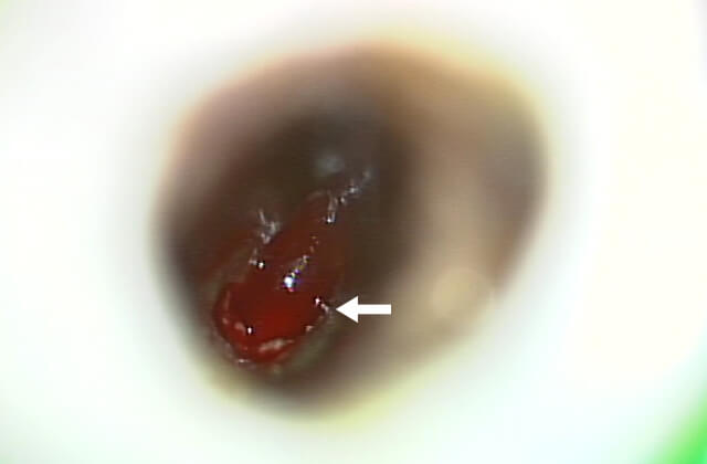 根尖部から出血が生じ肉芽組織