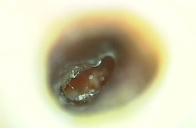 肉芽組織除去・止血