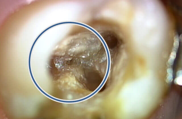 根管専用超音波チップを使用し細菌感染した歯質を除去していく