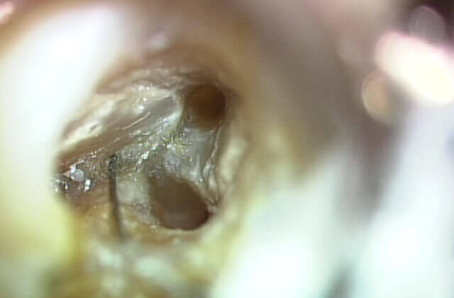 根管内を専用器具で治療