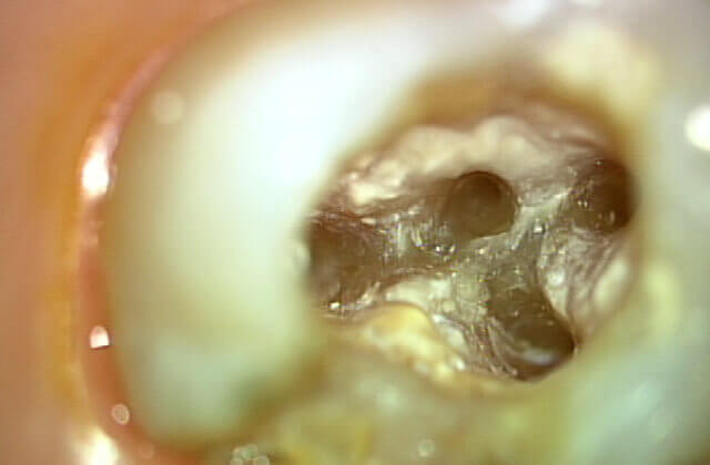 根管内の感染部を完全除去