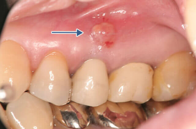 デキモノ・オデキ1