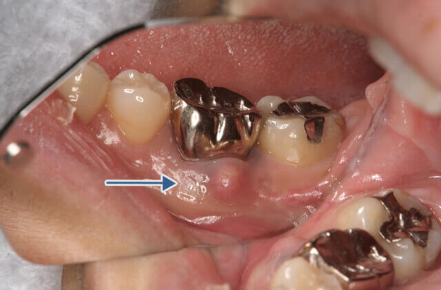 デキモノ・オデキ2