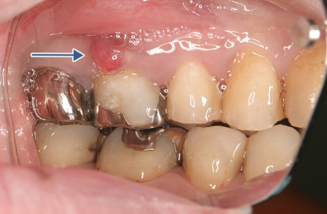 デキモノ・オデキ3