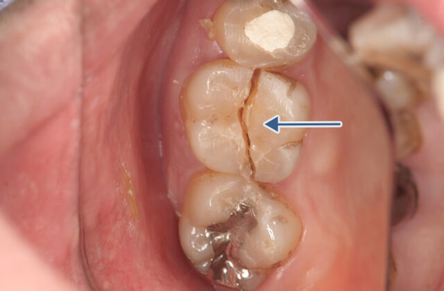 歯根破折に対する保存治療症例