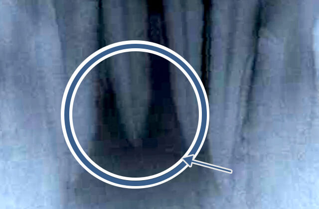 歯根周囲の大きな黒い影